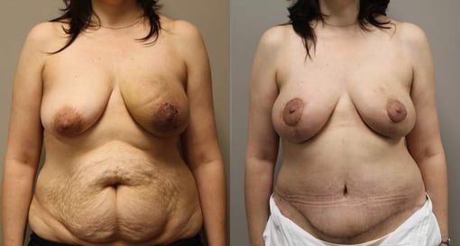 diep flap reconstruction before and after photos by kryger institute of plastic surgery in thousand oaks ca