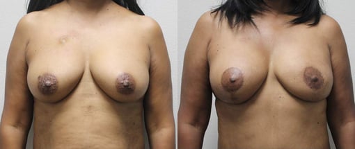 diep flap reconstruction before and after photos by kryger institute of plastic surgery in thousand oaks ca