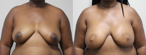 diep flap reconstruction before and after photos by kryger institute of plastic surgery in thousand oaks ca