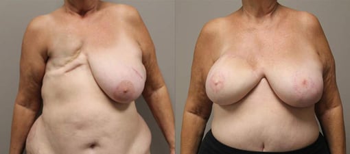 diep flap reconstruction before and after photos by kryger institute of plastic surgery in thousand oaks ca
