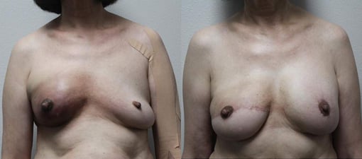 diep flap reconstruction before and after photos by kryger institute of plastic surgery in thousand oaks ca