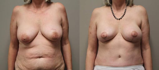 diep flap reconstruction before and after photos by kryger institute of plastic surgery in thousand oaks ca