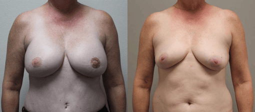 diep flap reconstruction before and after photos by kryger institute of plastic surgery in thousand oaks ca