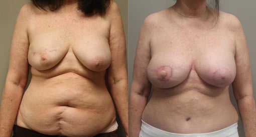 diep flap reconstruction before and after photos by kryger institute of plastic surgery in thousand oaks ca