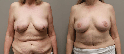 diep flap reconstruction before and after photos by kryger institute of plastic surgery in thousand oaks ca