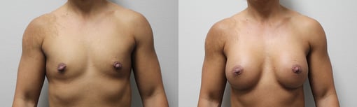 breast augmentation before and after photos by kryger institute of plastic surgery in thousand oaks ca