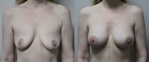 breast augmentation before and after photos by kryger institute of plastic surgery in thousand oaks ca