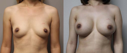 breast augmentation before and after photos by kryger institute of plastic surgery in thousand oaks ca