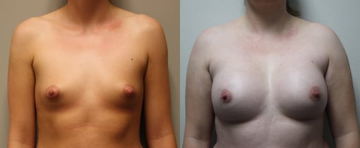 breast augmentation before and after photos by kryger institute of plastic surgery in thousand oaks ca