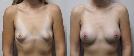 breast augmentation before and after photos by kryger institute of plastic surgery in thousand oaks ca