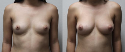 breast augmentation before and after photos by kryger institute of plastic surgery in thousand oaks ca