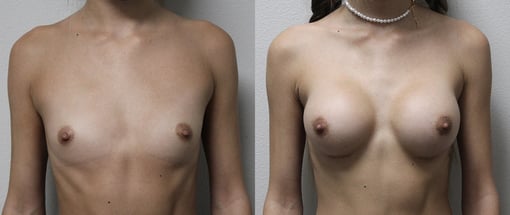 breast augmentation before and after photos by kryger institute of plastic surgery in thousand oaks ca
