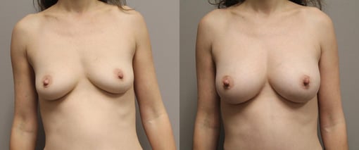 breast augmentation before and after photos by kryger institute of plastic surgery in thousand oaks ca
