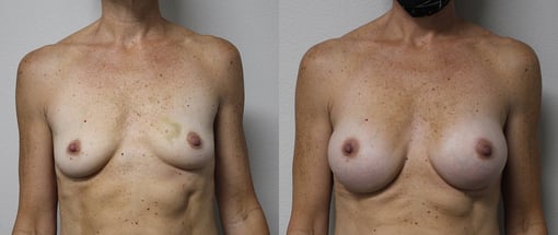 breast augmentation before and after photos by kryger institute of plastic surgery in thousand oaks ca