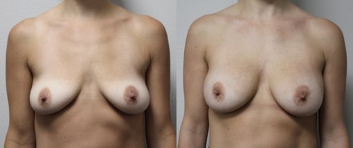 breast augmentation before and after photos by kryger institute of plastic surgery in thousand oaks ca