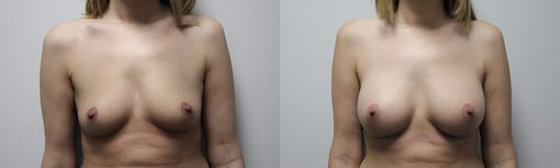 breast augmentation before and after photos by kryger institute of plastic surgery in thousand oaks ca