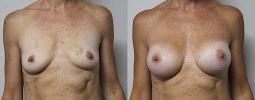 breast augmentation before and after photos by kryger institute of plastic surgery in thousand oaks ca