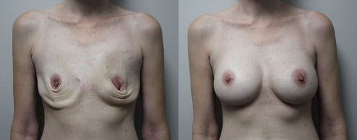 breast augmentation before and after photos by kryger institute of plastic surgery in thousand oaks ca