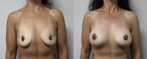 breast augmentation before and after photos by kryger institute of plastic surgery in thousand oaks ca