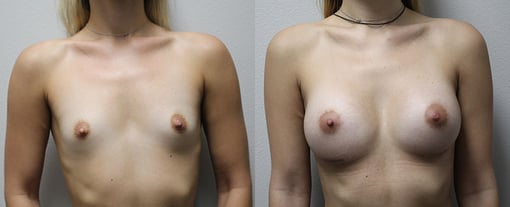 breast augmentation before and after photos by kryger institute of plastic surgery in thousand oaks ca