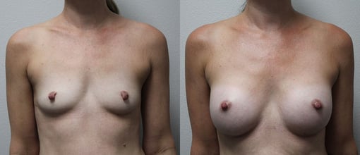 breast augmentation before and after photos by kryger institute of plastic surgery in thousand oaks ca
