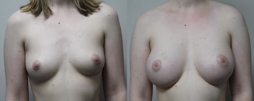 breast augmentation before and after photos by kryger institute of plastic surgery in thousand oaks ca