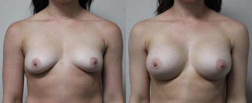 breast augmentation before and after photos by kryger institute of plastic surgery in thousand oaks ca