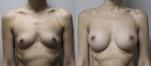 breast augmentation before and after photos by kryger institute of plastic surgery in thousand oaks ca