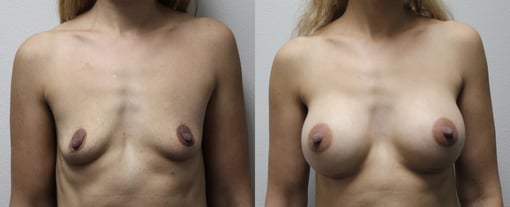 breast augmentation before and after photos by kryger institute of plastic surgery in thousand oaks ca