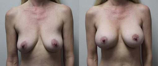 breast augmentation before and after photos by kryger institute of plastic surgery in thousand oaks ca