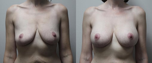 breast augmentation before and after photos by kryger institute of plastic surgery in thousand oaks ca