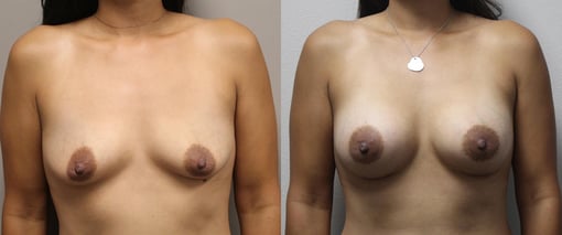 breast augmentation before and after photos by kryger institute of plastic surgery in thousand oaks ca