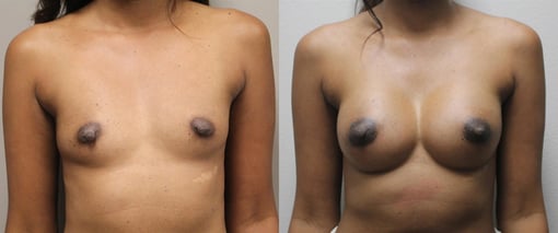 breast augmentation before and after photos by kryger institute of plastic surgery in thousand oaks ca