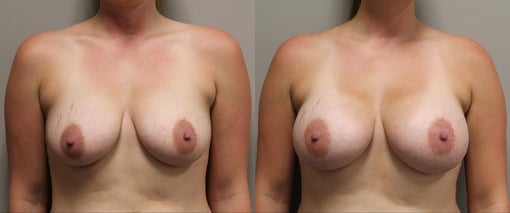 breast augmentation before and after photos by kryger institute of plastic surgery in thousand oaks ca
