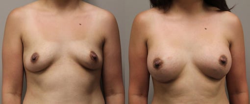 breast augmentation before and after photos by kryger institute of plastic surgery in thousand oaks ca