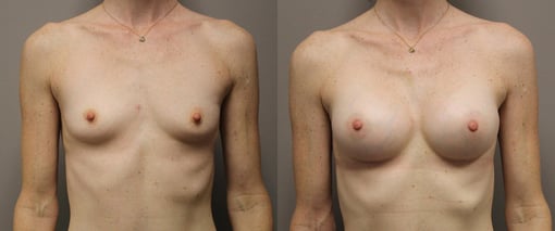 breast augmentation before and after photos by kryger institute of plastic surgery in thousand oaks ca