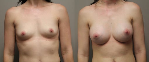 breast augmentation before and after photos by kryger institute of plastic surgery in thousand oaks ca