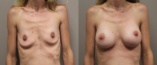 breast augmentation before and after photos by kryger institute of plastic surgery in thousand oaks ca