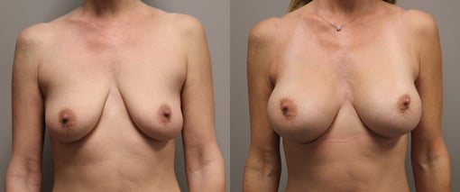 breast augmentation before and after photos by kryger institute of plastic surgery in thousand oaks ca