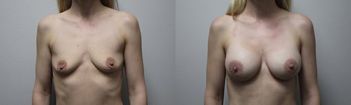 breast augmentation before and after photos by kryger institute of plastic surgery in thousand oaks ca
