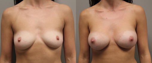 breast augmentation before and after photos by kryger institute of plastic surgery in thousand oaks ca
