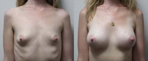 breast augmentation before and after photos by kryger institute of plastic surgery in thousand oaks ca