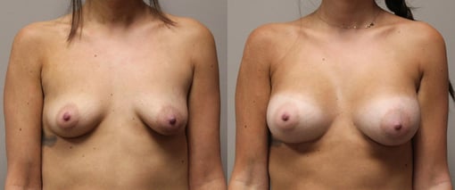 breast augmentation before and after photos by kryger institute of plastic surgery in thousand oaks ca
