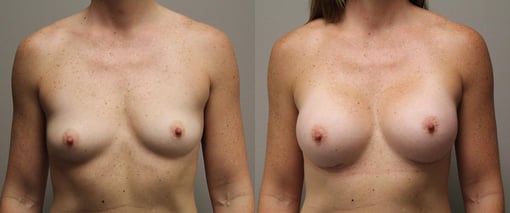 breast augmentation before and after photos by kryger institute of plastic surgery in thousand oaks ca