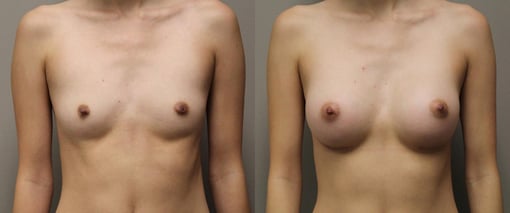 breast augmentation before and after photos by kryger institute of plastic surgery in thousand oaks ca