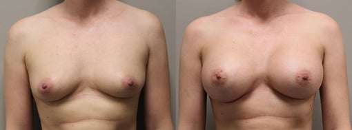 breast augmentation before and after photos by kryger institute of plastic surgery in thousand oaks ca
