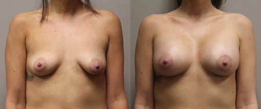 breast augmentation before and after photos by kryger institute of plastic surgery in thousand oaks ca