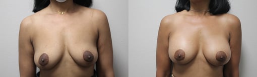 breast augmentation before and after photos by kryger institute of plastic surgery in thousand oaks ca