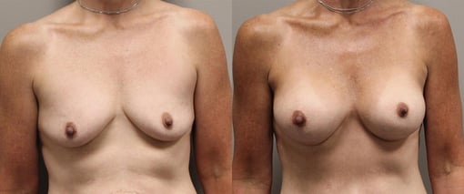 breast augmentation before and after photos by kryger institute of plastic surgery in thousand oaks ca