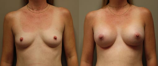 breast augmentation before and after photos by kryger institute of plastic surgery in thousand oaks ca